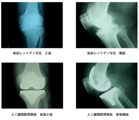 人工膝関節置換術の症例