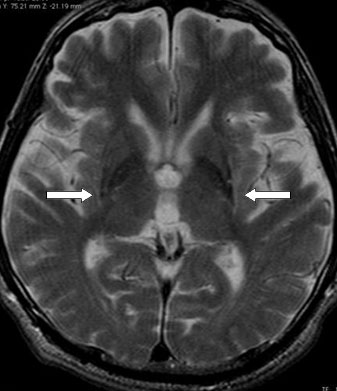 図１ MSA-Pの脳MRI所見