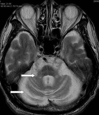 図２ MSA-Cの脳MRI所見