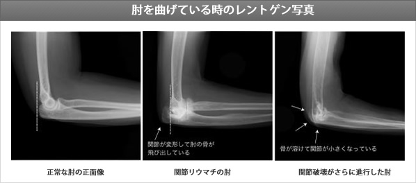 正常な肘関節と関節リウマチのために関節が壊れてきた例のレントゲン写真