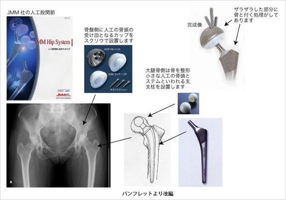 人工関節に置き換えて痛みなく関節が動くようにする手術