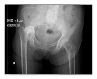 関節リウマチで右の股関節が悪くなった患者さんのレントゲン写真