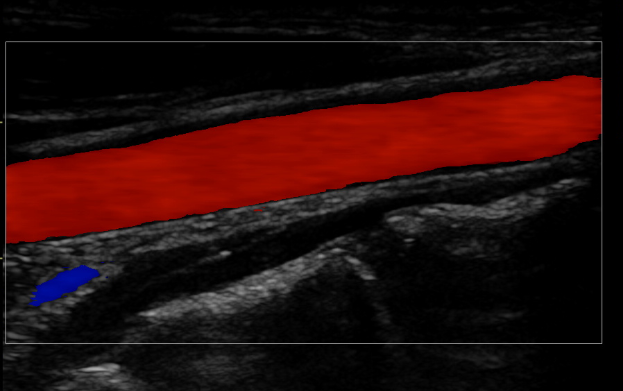 頸動脈エコー画像の一例