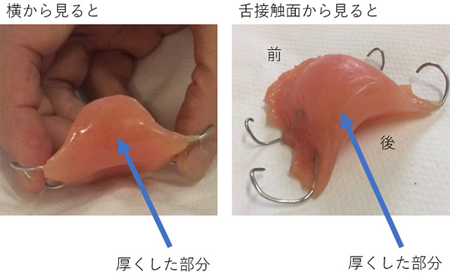 舌接触補助床