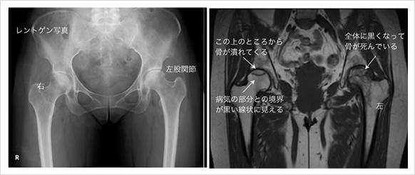 リウマチ性股関節症 リウマチ 関節センター 整形外科部門 診療科 部門 宇多野病院