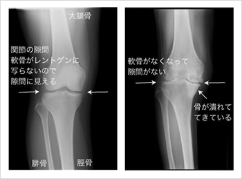 リウマチ性膝関節症 リウマチ 関節センター 整形外科部門 診療科 部門 宇多野病院