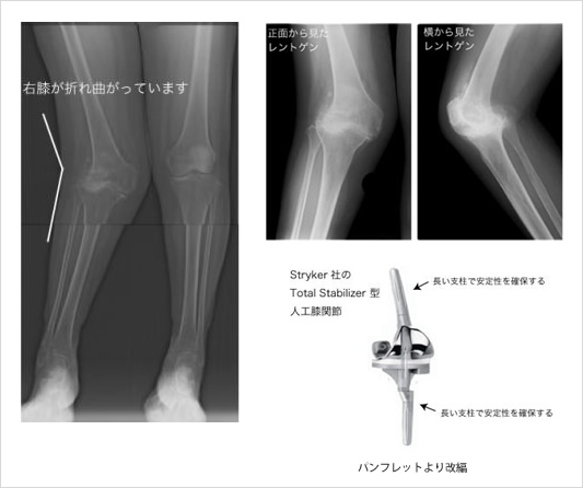 リウマチ性膝関節症│リウマチ・関節センター【整形外科部門】|診療科