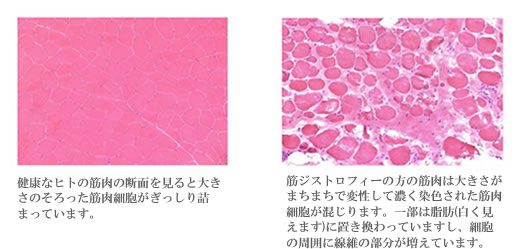 筋肉の病気の話 病気について知りたい その他のとりくみ 宇多野病院 筋肉の病気の話 病気について知りたい その他のとりくみ 宇多野病院